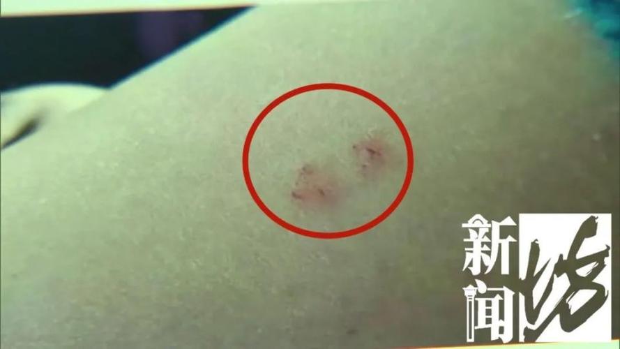被蛇咬反抓蛇再遭咬,被蛇咬反抓蛇再遭咬伤